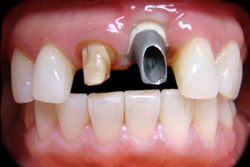 Implant Abutment