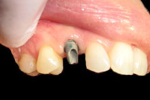 Implant Abutment