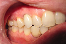 After Treatment Implant in Mouth