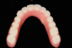 Upper Denture