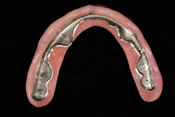 Implant Bar