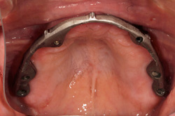 Implant Bar