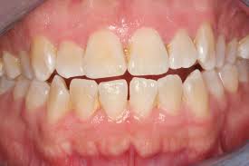 periodontal disease treatment